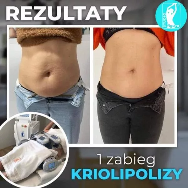 kriolipoliza-3